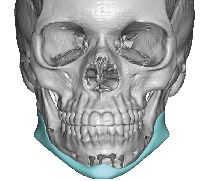 Plastic Surgery Case Study - V Line Reversal Surgery with a Custom ...