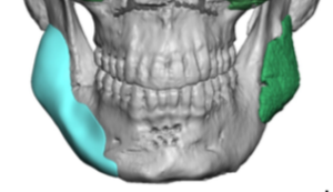 Plastic Surgery Case Study - Asymmetry Correction Using A Custom Jaw ...