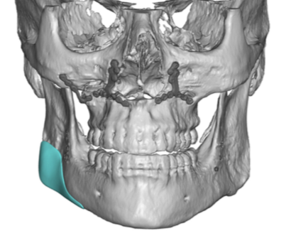 Plastic Surgery Case Study - Custom Jaw Angle Implant For Asymmetry ...