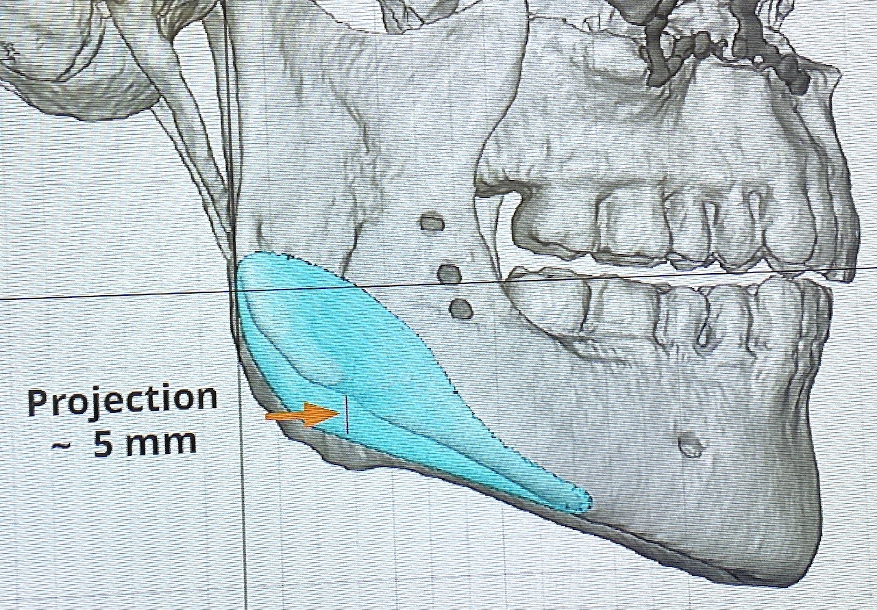 Plastic Surgery Case Study Custom Jaw Angle Implant For Asymmetry