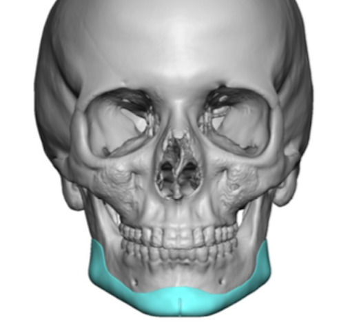 Plastic Surgery Case Study - Custom Jawline Implant to Create the Well ...