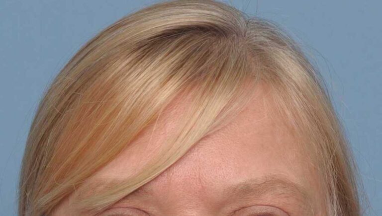 Plastic Surgery Case Study - Long Term Outcome from Female Frontal