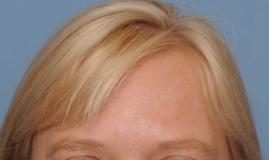 Plastic Surgery Case Study - Long Term Outcome from Female Frontal