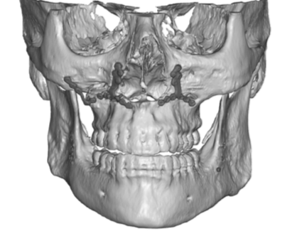 Plastic Surgery Case Study - Custom Jaw Angle Implant For Asymmetry ...