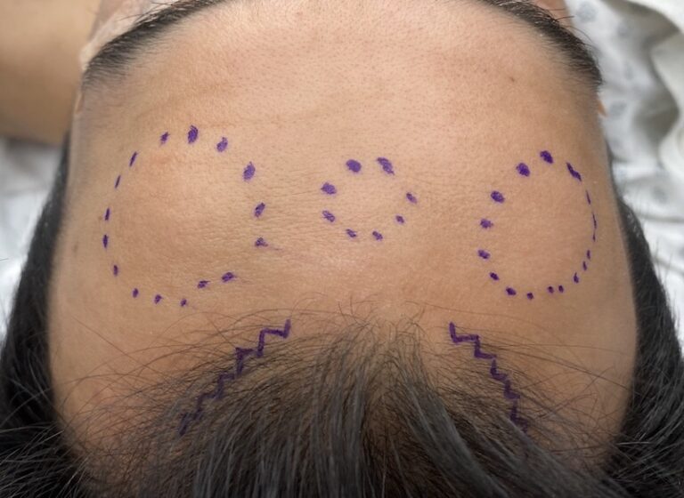 Plastic Surgery Case Study Male Asymmetric Forehead Horn Reductions (Upper Forehead Contouring