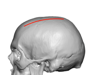 parasagittal indentations occur