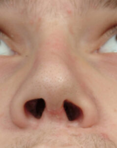 Correction of Maxillary Deficiencies in Deviated Nose Rhinoplasty ...