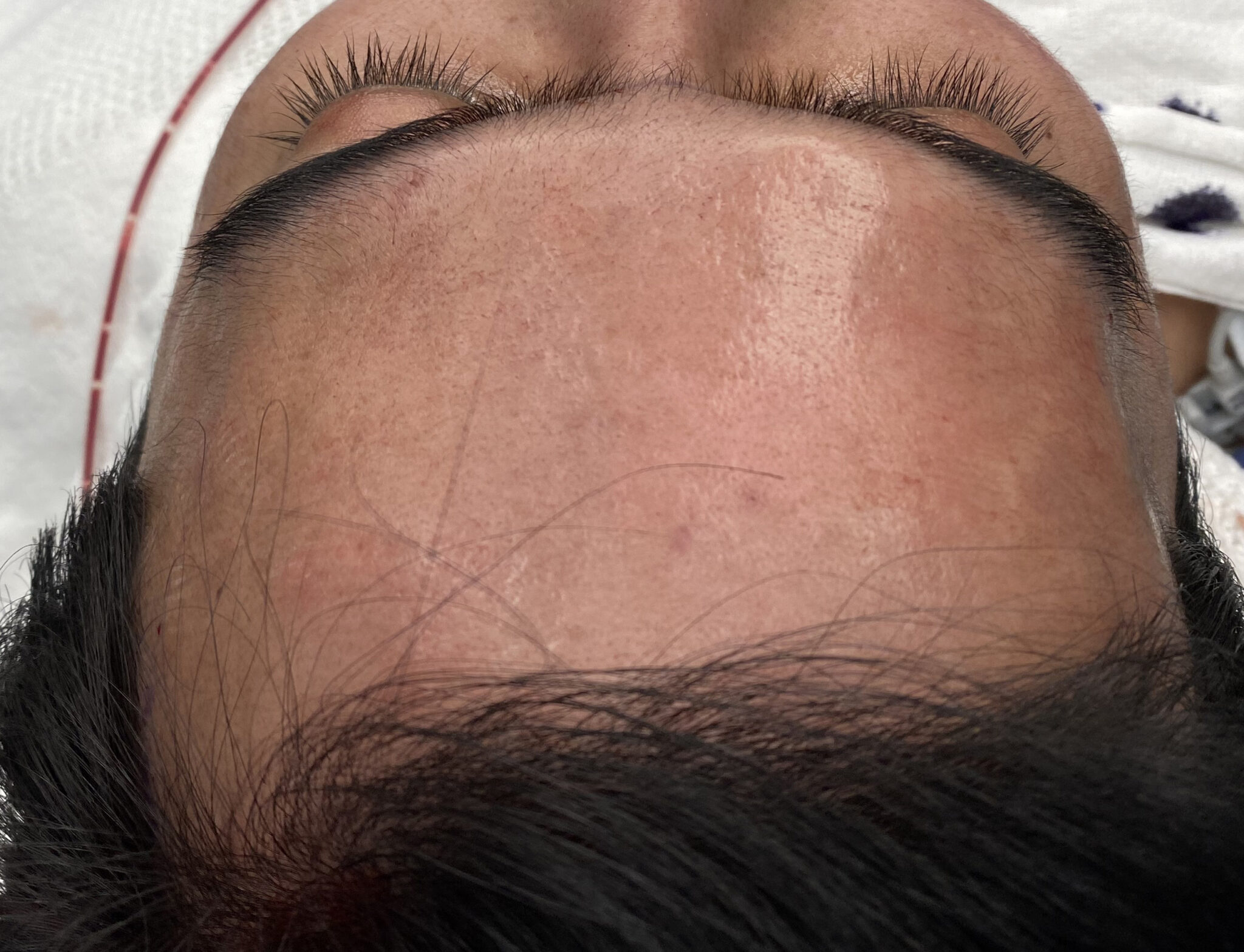 Plastic Surgery Case Study Upper Facial Masculinization with a Custom