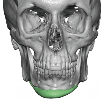 Chin Implant Placement and the Relevance of the Osteocutaneous ...