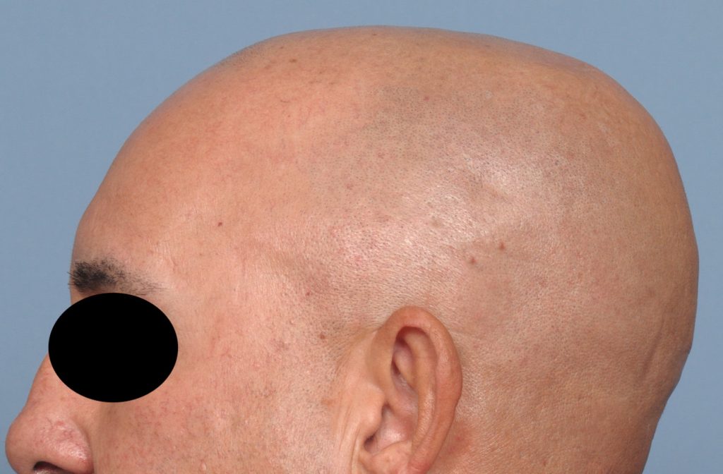 Male Custom Brow Bone And Skull Implants Result Side View Dr Barry
