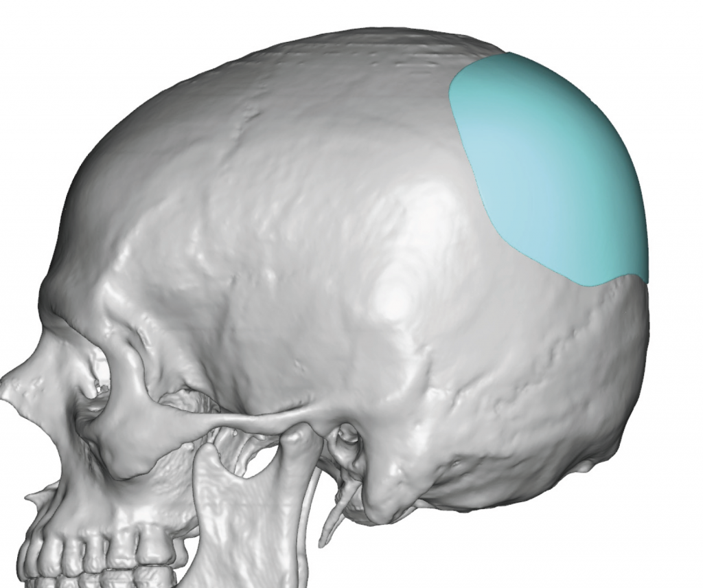 Plastic Surgery Case Study Custom Skull Implant for Male Residual