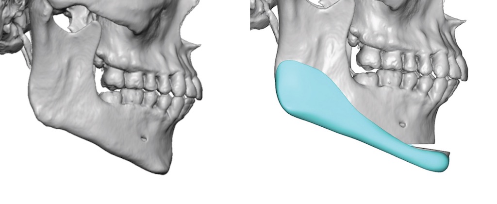 Male Sliding Genioplasty And Custom Jawline Implants Design Side View 