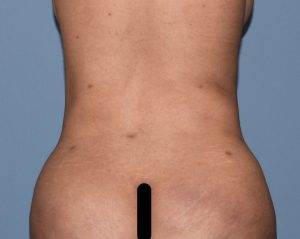 Postoperative Corset vs Waist Trainers in Rib Removal Waistline Narrowing  Surgery - Explore Plastic Surgery