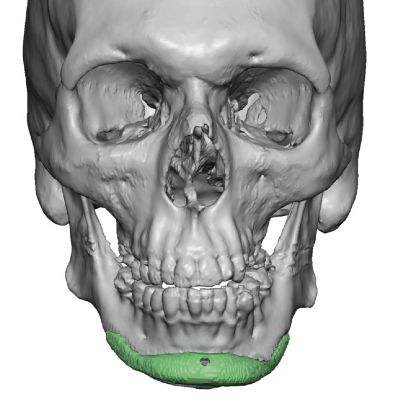 Plastic Surgery Case Study - Secondary Custom Jaw Angles Implants After ...