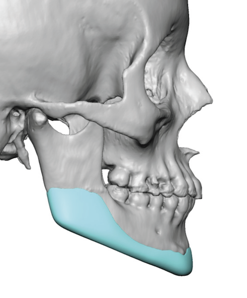 Design Considerations in Male vs Female Jawline Implants - Explore ...