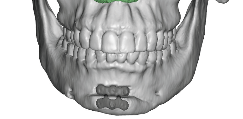 Plastic Surgery Case Study - Custom Jawline Implants For Correcting ...