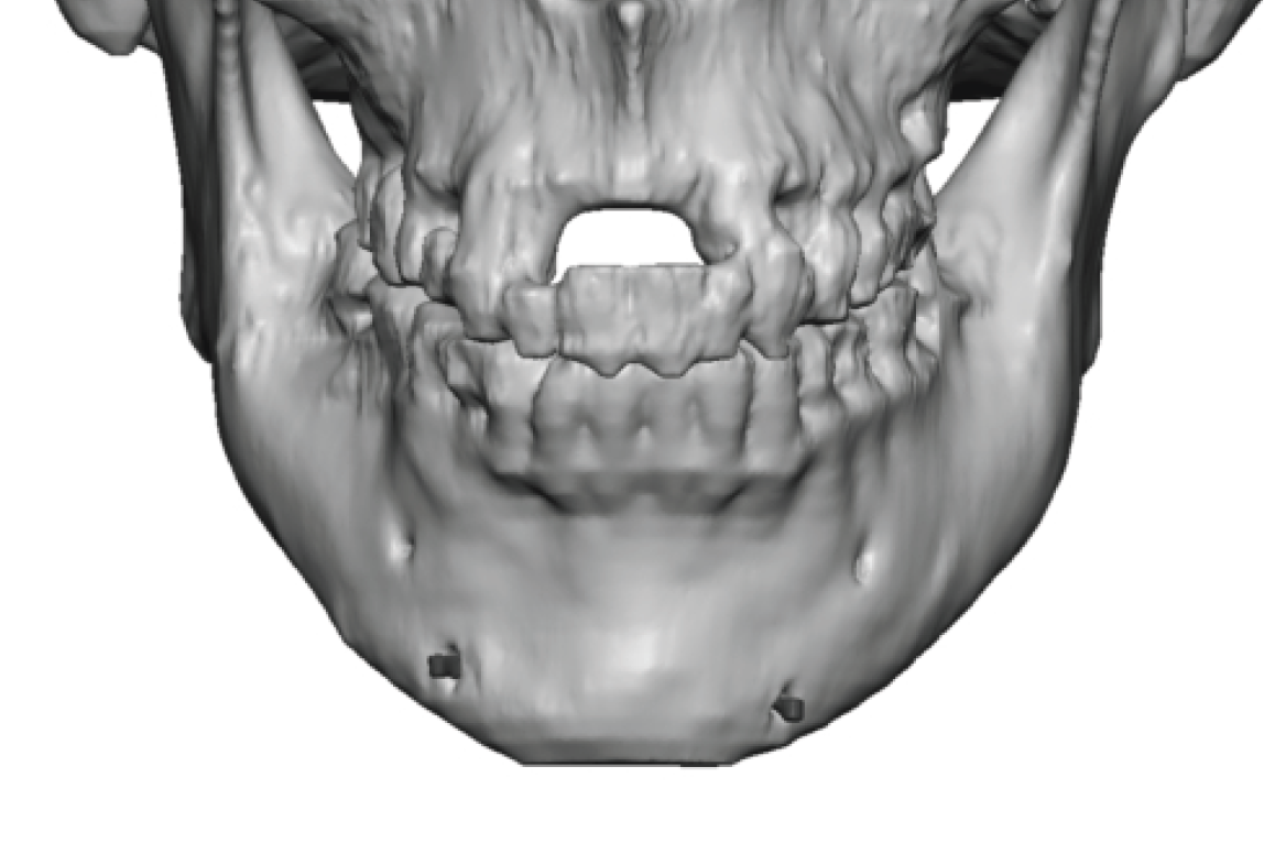 female medpor chin implant 1 3D CT scan front view Dr Barry Eppley ...