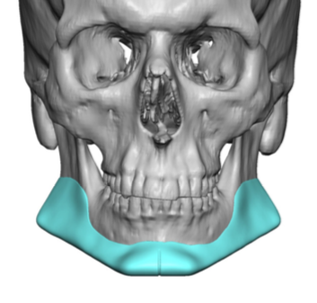 male custom jawline implant design front view Dr Barry Eppley ...