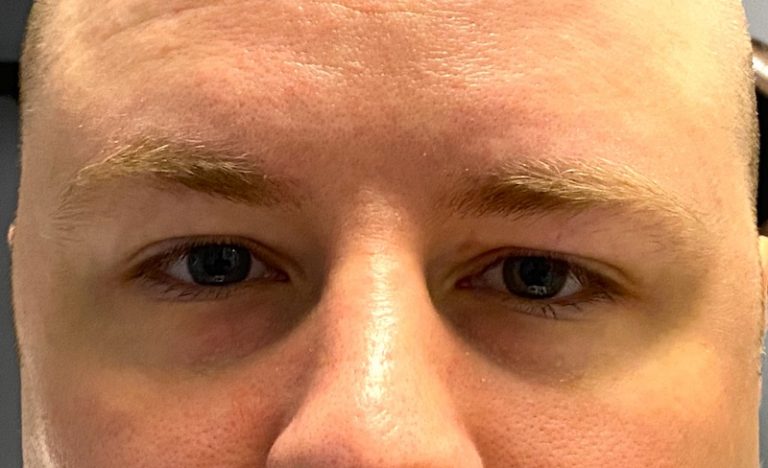 male left vertical orbital dystopia - Explore Plastic Surgery