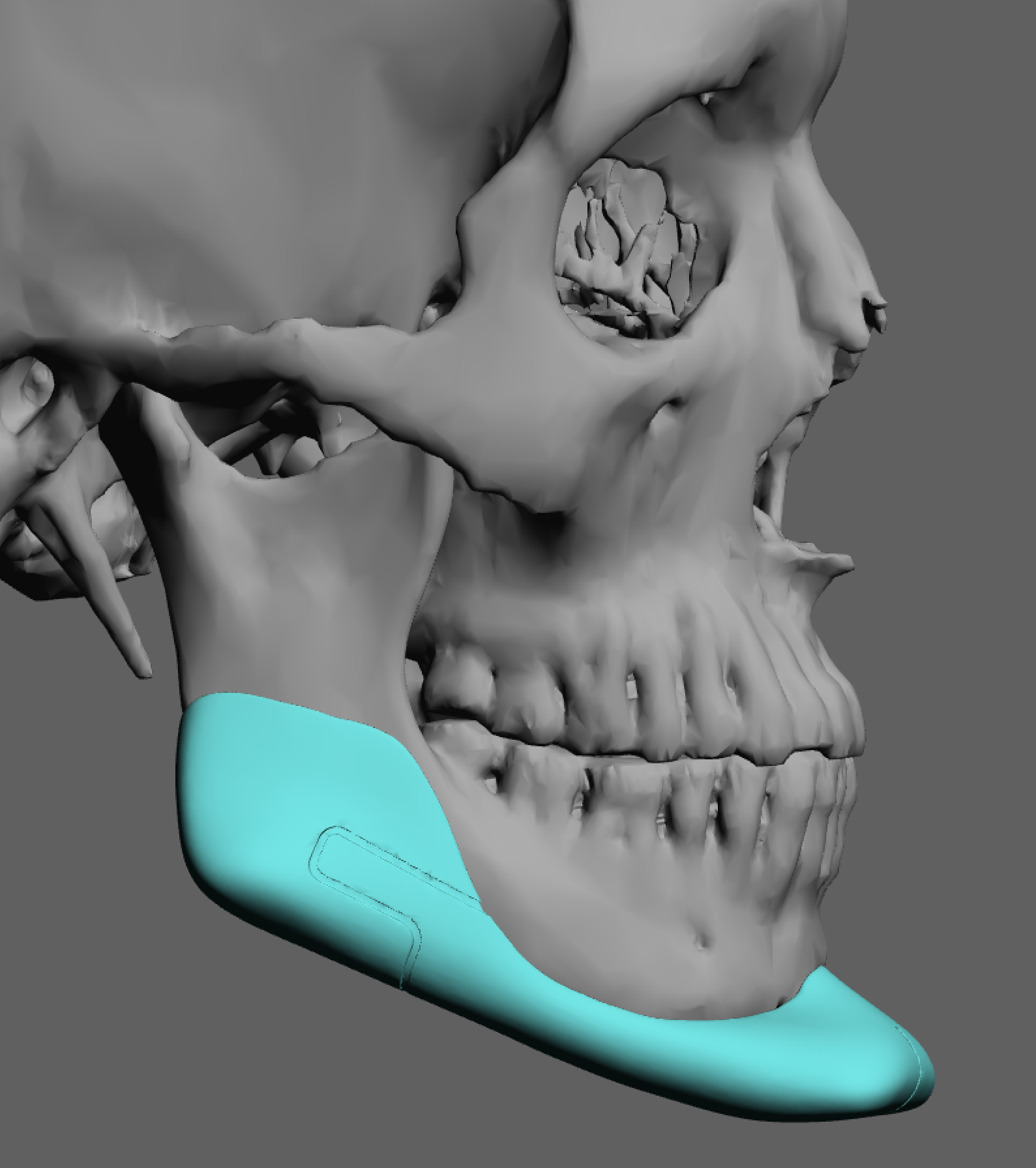 Plastic Surgery Case Study Large Male Custom Jawline Implant Result Explore Plastic Surgery