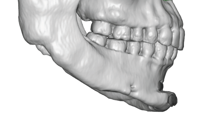 Plastic Surgery Case Study - Custom Jawline Implants For Correcting ...