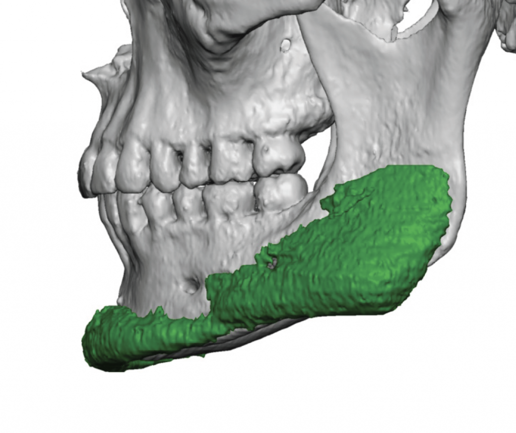 Technical Strategies - Screw Preplacement in Jaw Angle Implant Bone ...