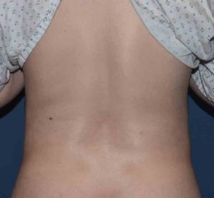 The Five Critical Steps in Waistline Narrowing By Rib Removal Surgery -  Explore Plastic Surgery