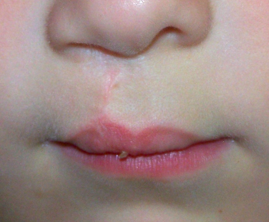 Plastic Surgery Case Study - Adult Cleft Lip Revision Using A Rotation ...