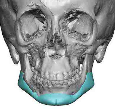 Female custom jawline implant design after sagittal split osteotomies ...