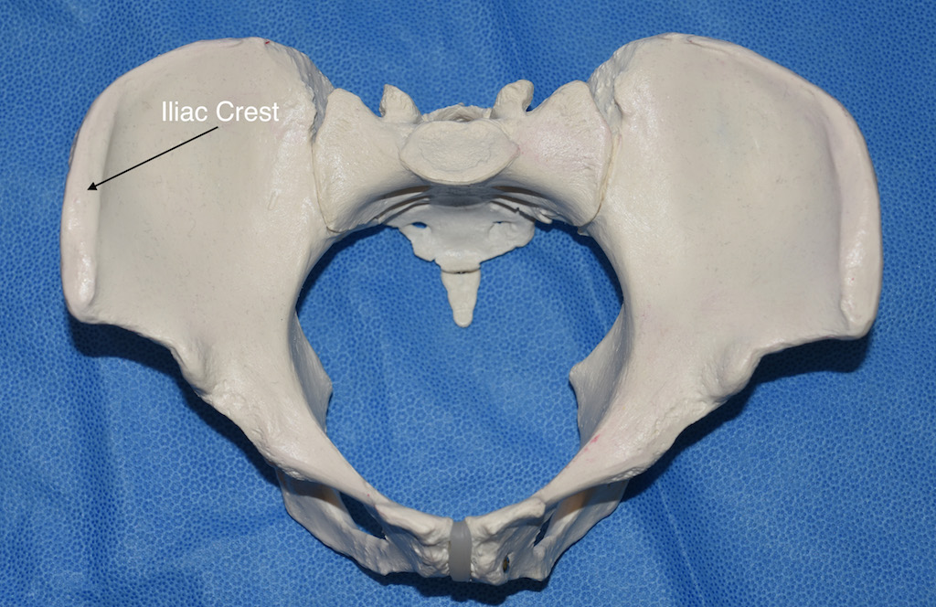 Hip Widening By Iliac Crest Bone Implant Augmentation Concept and