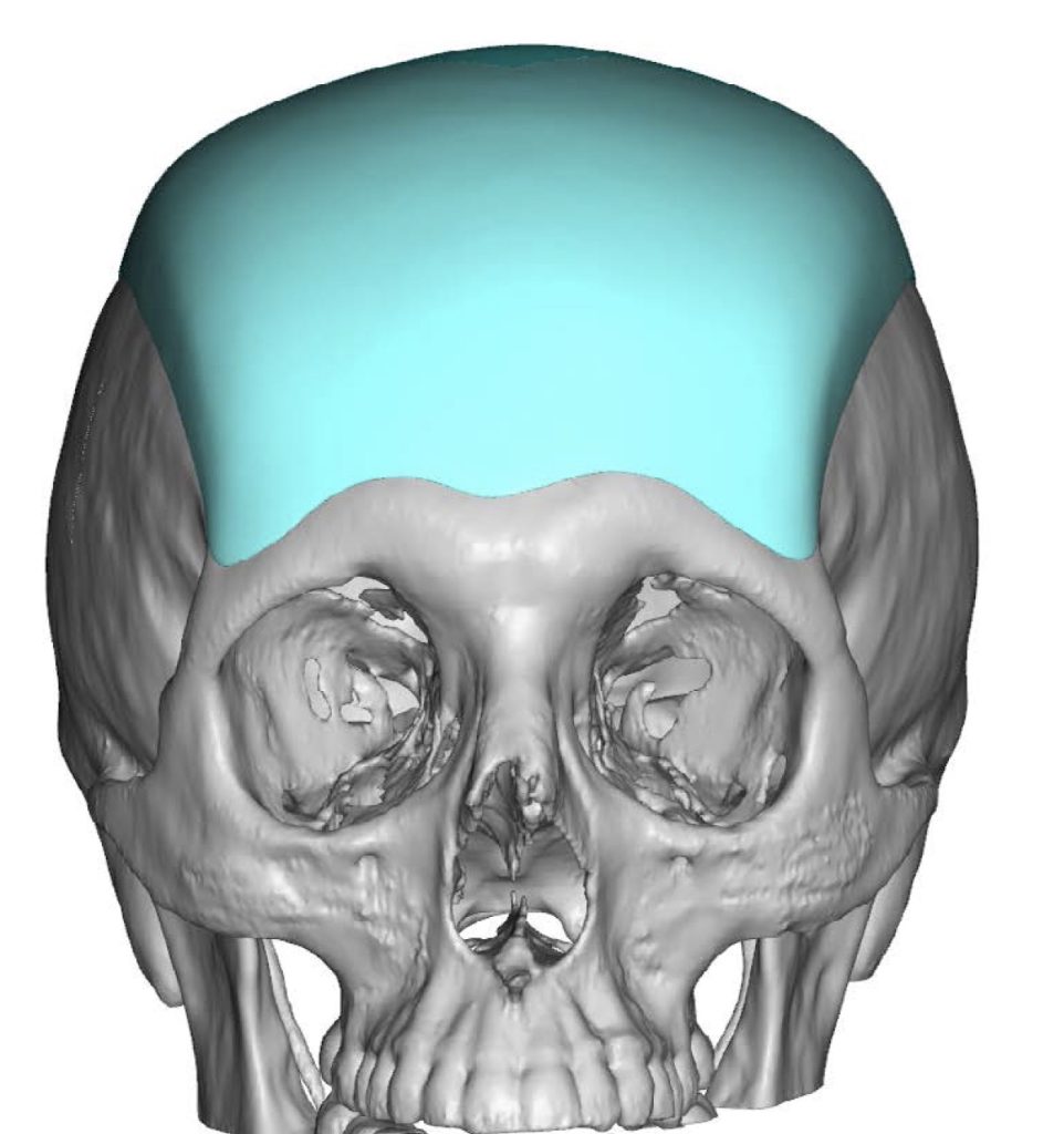 Plastic Surgery Case Study - Male Custom Extended Forehead-Skull ...