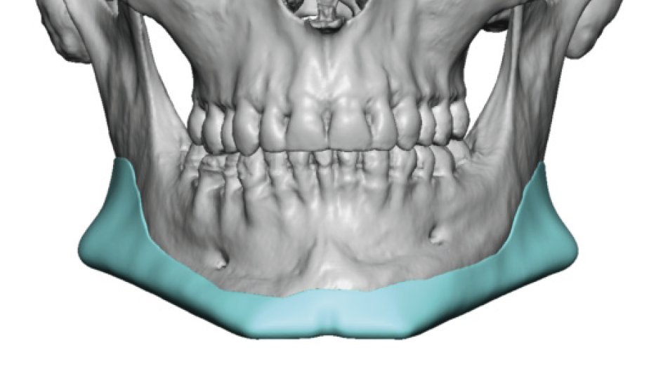 male custom jawline implant design for asymmetry front view Dr Barry ...