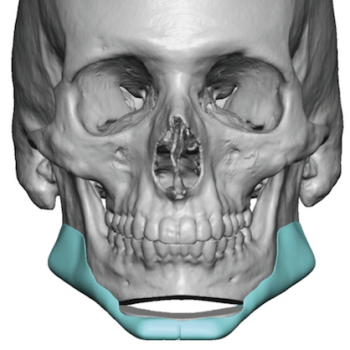 sliding genioplasty Archives - Page 4 of 13 - Explore Plastic Surgery