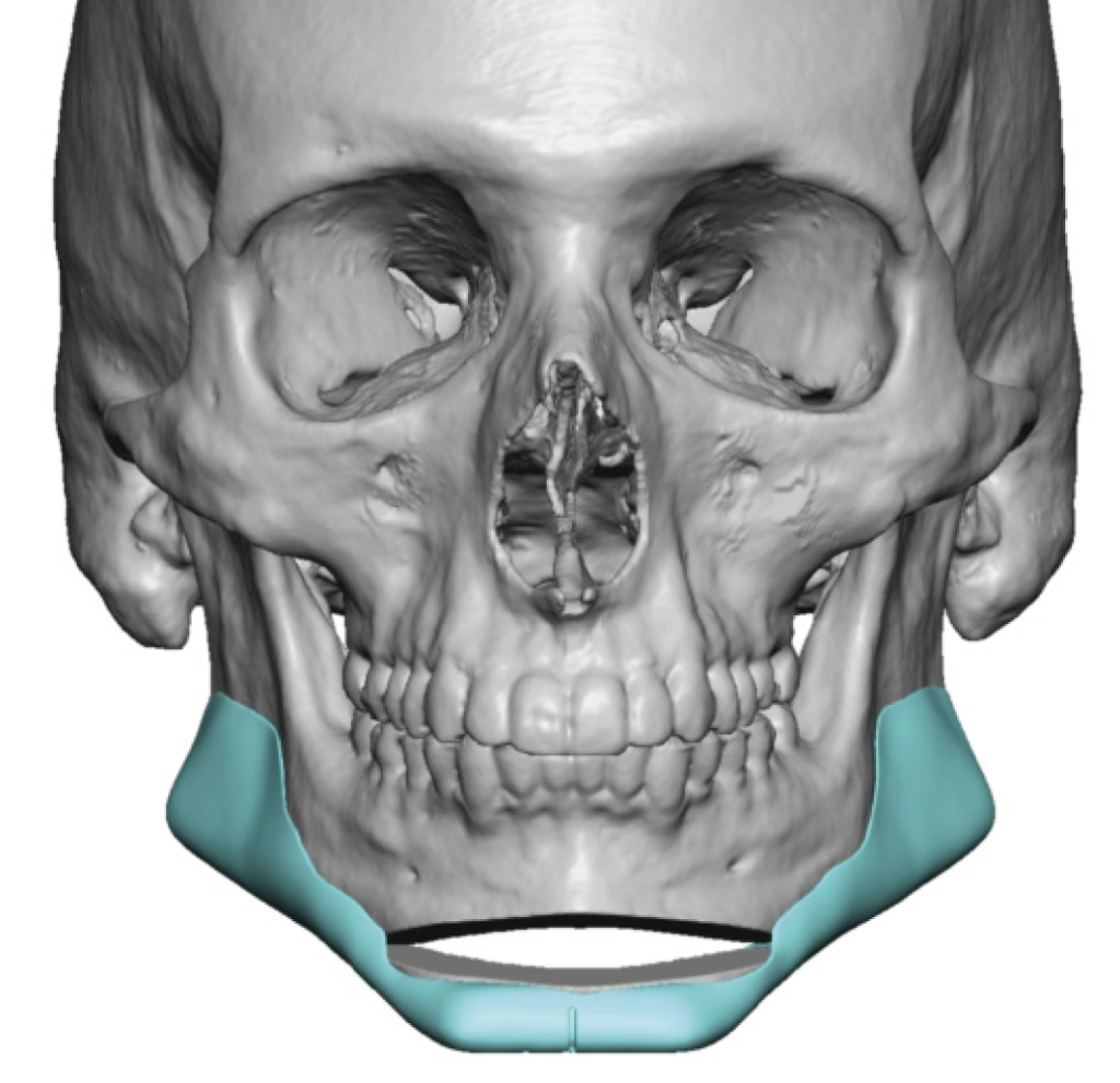 Technical Strategies - Opening Wedge Genioplasty with Custom Jawline ...