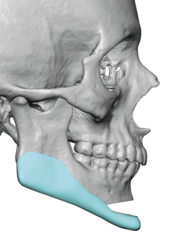 Technical Strategies - Opening Wedge Genioplasty with Custom Jawline ...