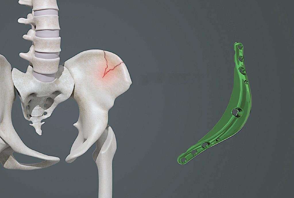 Hip Widening By Iliac Crest Bone Implant Augmentation - Concept and