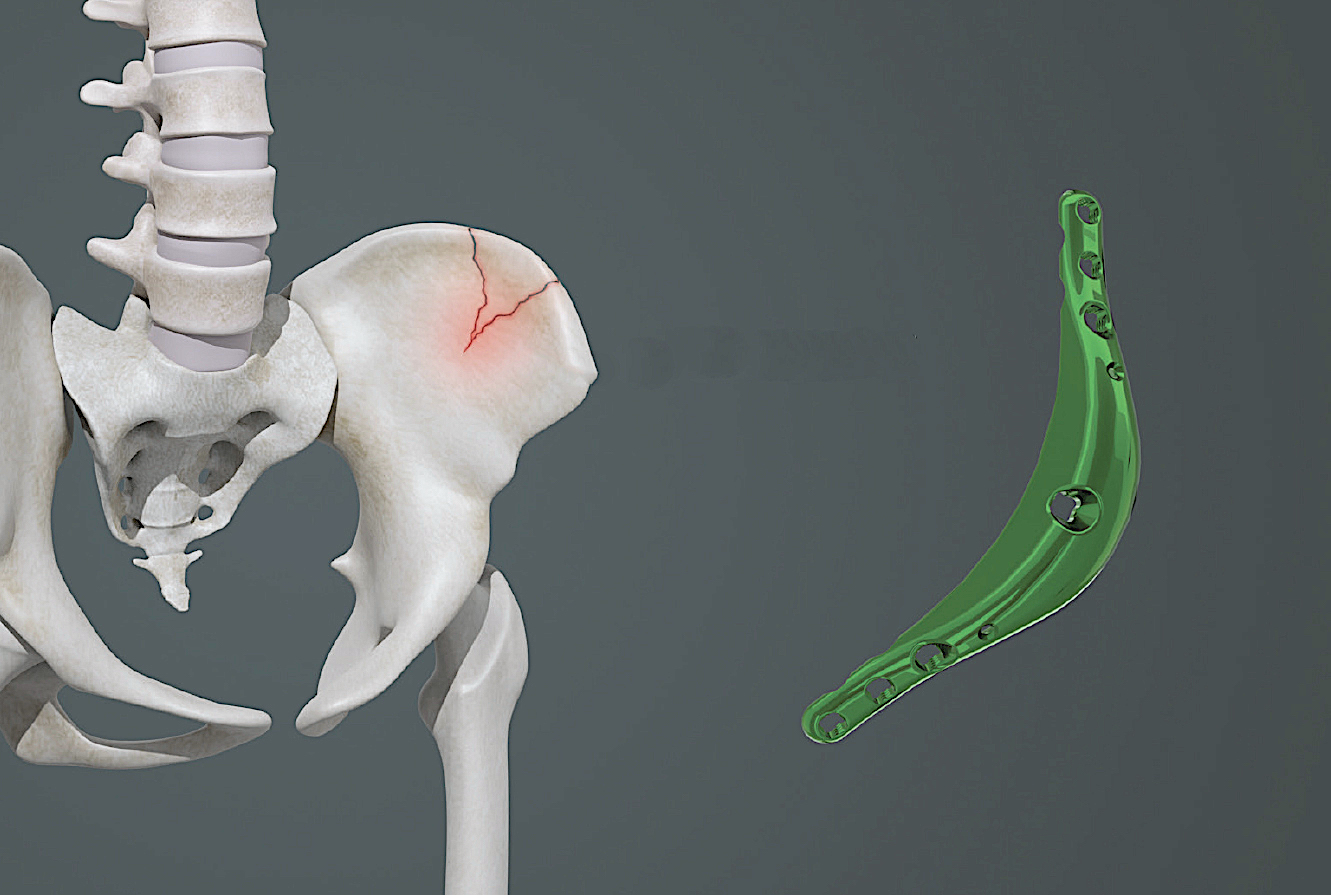 Hip Widening By Iliac Crest Bone Implant Augmentation - Concept
