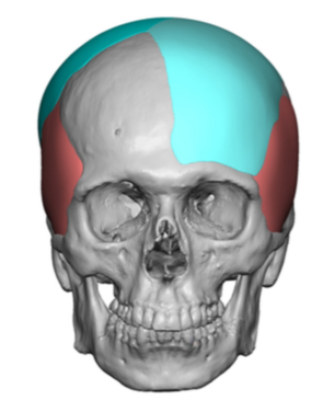 two piece custom skull implant design for complete plagiocephaly ...