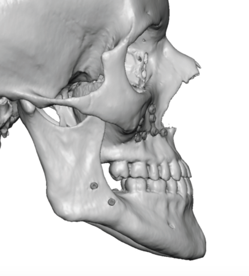 Plastic Surgery Case Study - Custom Midface Implant for Total Midface ...