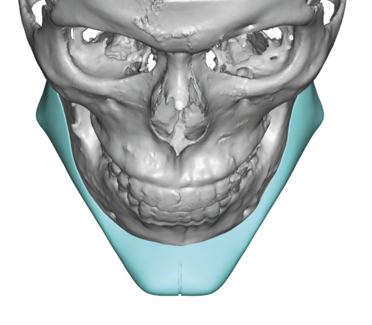 angular jawline implant design top view Dr Barry Eppley Indianapolis ...