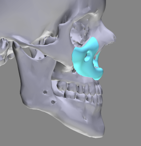 Plastic Surgery Case Study - Custom Midface Implant for Total Midface  Augmentation Completion After LeFort I Advancement - Explore Plastic Surgery