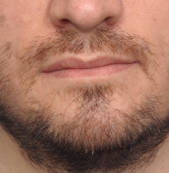 Technical Strategies Extended Corner of Mouth Lift in Facial