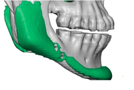 Plastic Surgery Case Study - Custom Jawline Implant Replacement ...