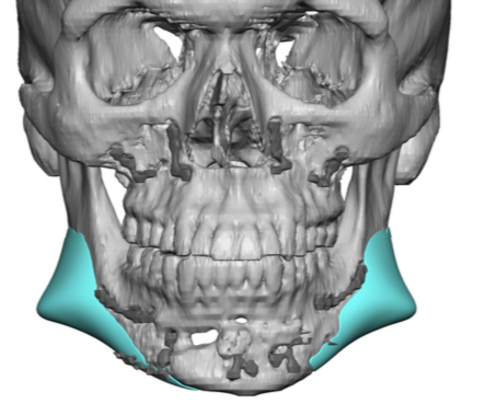 custom jaw implants design after BSSO surgery front view Dr Barry ...