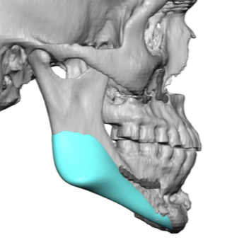 custom jaw implants design after BSSO surgery side view Dr Barry Eppley ...