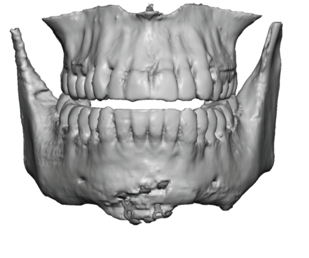 Plastic Surgery Case Study - Female Custom Chin Implant for a Tapered V ...