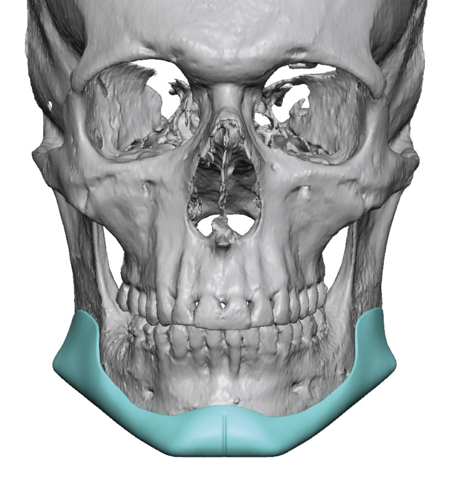 male custom jawline implant replaccement 3D CT scam front view Dr Barry ...