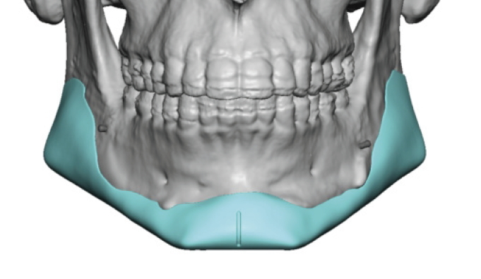 Plastic Surgery Case Study - Replacement of Standard Chin and Jaw Angle ...