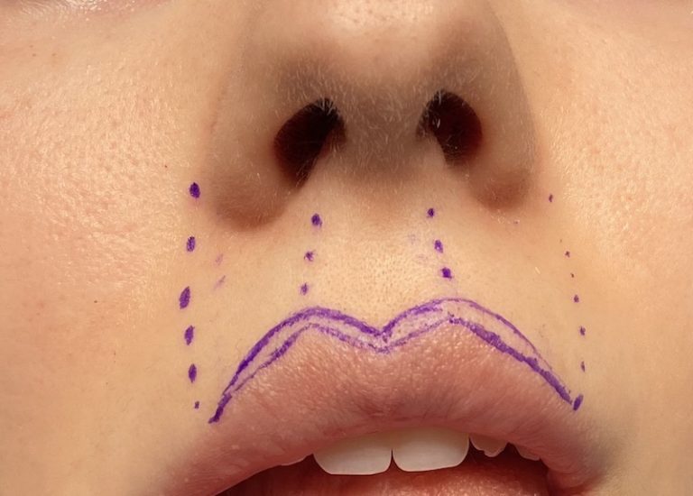 Techniques In Cupids Bow Reshaping Of The Upper Lip Explore Plastic