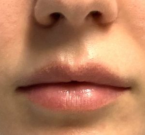 Techniques in Cupid's Bow Reshaping of the Upper Lip - Explore Plastic  Surgery